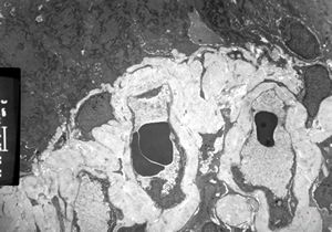 F,45y. | jejunum … amyloidosis